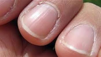 للنساء.. طرق للتخلص من الزوائد الجلدية حول الأظافر في الشتاء