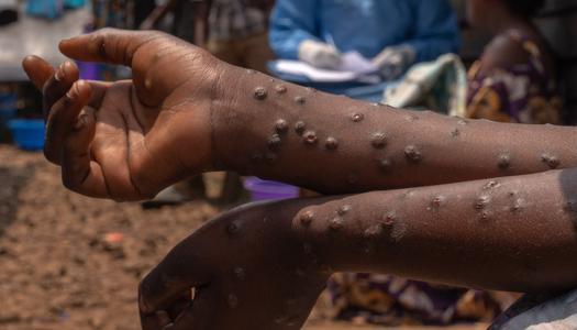 تقدم في أبحاث علاج جدري القردة بإفريقيا بعد مراجعة إيجابية لبيانات السلامة