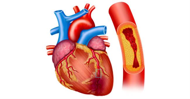 أعراض قصور الشريان التاجي المبكرة والمتقدمة