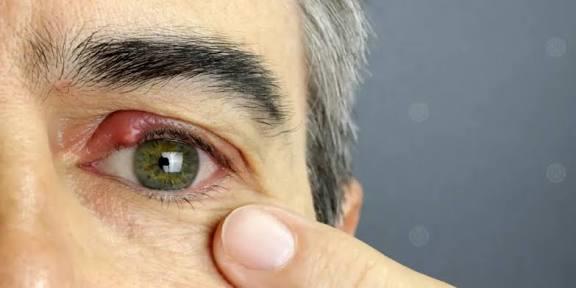 أسباب  الإصابة بدمل العين وأعراضه
