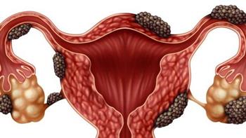 نصائح للوقاية من الأورام الليفية