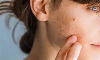 لجمالك.. طرق طبيعية لعلاج ندبات حب الشباب
