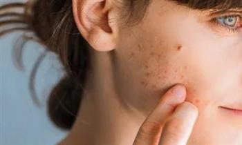 لجمالك.. طرق طبيعية لعلاج ندبات حب الشباب