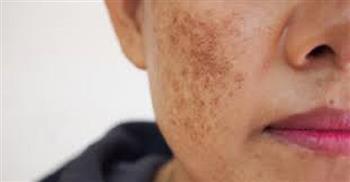 بقع داكنة أم تصبغات أم كلف؟ تعرفي على أهم الفروق