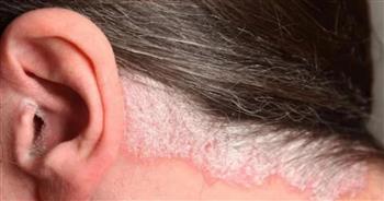 تعرف على أسباب صدفية الأذن