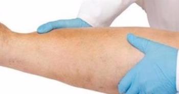 فى الصيام .. تعرف على أعراض انسداد شرايين الساقين