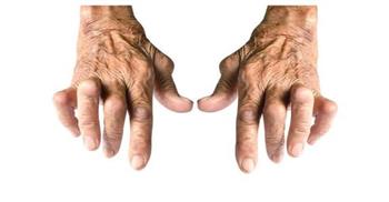 نصائح لمرضى الروماتيزم في رمضان