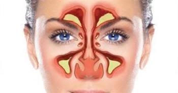 الفرق بين نزلات البرد وإلتهاب الجيوب الأنفية