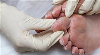 بهذة الطريقة..تجنب إصابات القدم لمرضى السكري