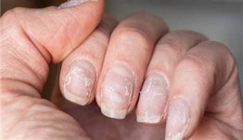 طرق الوقاية من تشقق وضعف الأظافر