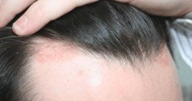 انتبه..مضاعفات الصدفية 