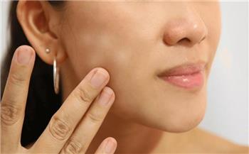 انتبه...مضاعفات صحية ونفسية لمرض البهاق