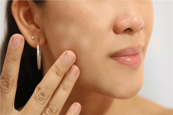 انتبه...مضاعفات صحية ونفسية لمرض البهاق