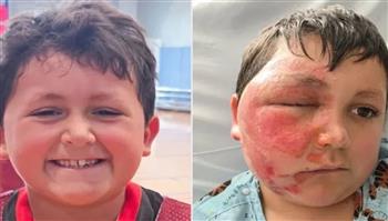 "تحدي الميكروويف".. تيك توك يسبب حروقًا خطيرة لطفل