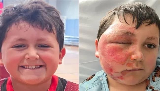 "تحدي الميكروويف".. تيك توك يسبب حروقًا خطيرة لطفل