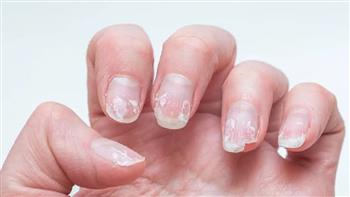 أسباب هشاشة الأظافر وطرق علاجها