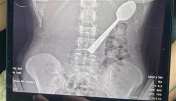بلجيكا.. شابة تبتلع ملعقة طولها 17 سنتيمترًا عن طريق الخطأ