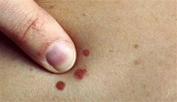 6   أعراض لسرطان الجلد… لا تتجاهلها