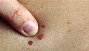 6   أعراض لسرطان الجلد… لا تتجاهلها