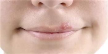 كيف تتعامل مع الهربس الفموي؟ 