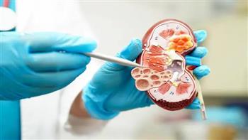 لإفطار صحى لمرضى حصوات الكلى في رمضان .. اتبع الآتى