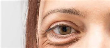 أسباب تدلّي الجفن!