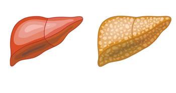 10 خطوات للتخلص من الكبد الدهني