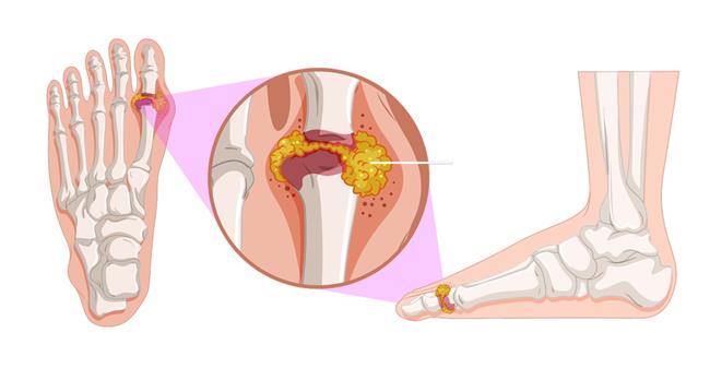نصائح لمرضى النقرس أثناء الصيام