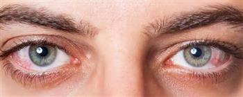 انتبه.. جفاف العين قد يكون علامة على مشكلة في الغدة الدرقية