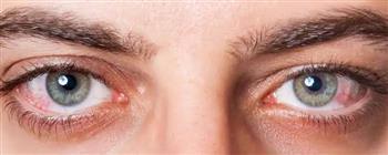 انتبه.. جفاف العين قد يكون علامة على مشكلة في الغدة الدرقية