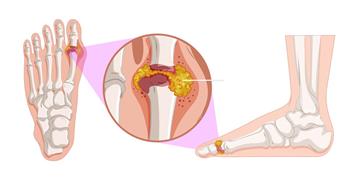 نصائح لمرضى النقرس أثناء الصيام