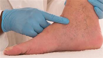 أعراض انسداد شرايين القدم