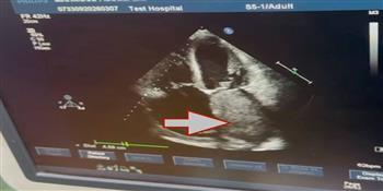 رئيس جامعة القاهرة يهنئ فريق قصر العيني بنجاح استئصال ورم نادر من قلب مريض يبلغ من العمر 70 عاما