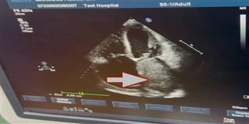 رئيس جامعة القاهرة يهنئ فريق قصر العيني بنجاح استئصال ورم نادر من قلب مريض يبلغ من العمر 70 عاما