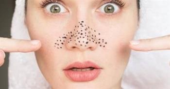 لاطلالة صحية في العيد ..نصائح للتخلص  من الرؤوس السوداء