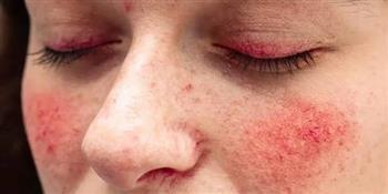 مرضى الذئبة الحمراء والصيام