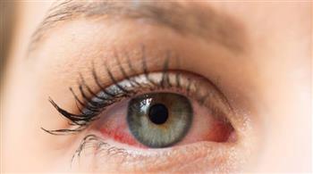 أعراض جفاف العين