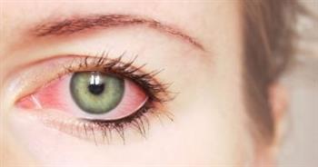 أسباب لحمية العين وأعراضها