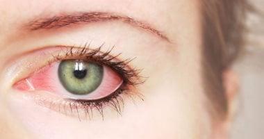 أسباب لحمية العين وأعراضها