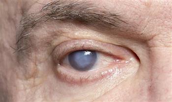 4 خطوات لحماية العين من مضاعفات السكري