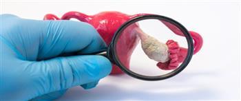 انتبه..لأنواع أكياس المبيض