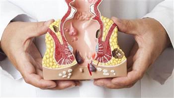 أهم أعراض الإصابة بالبواسير