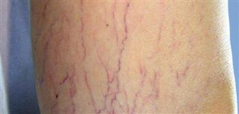 لتقليل ظهور الدوالي .. تجنب الوقوف لفترات طويلة