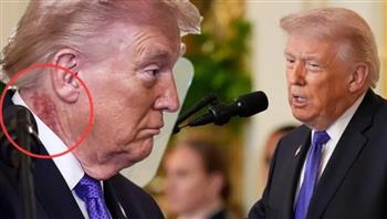 سر البقعة الحمراء على رقبة ترامب.. البيت الأبيض يحسم الجدل ببيان رسمي