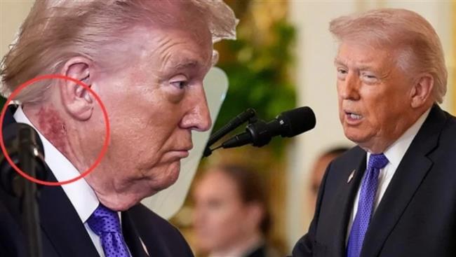 سر البقعة الحمراء على رقبة ترامب.. البيت الأبيض يحسم الجدل ببيان رسمي