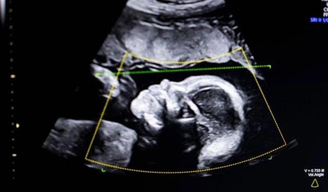 أمريكا تجيز استخدام تقنية تتنبأ بموعد الولادة بالذكاء الاصطناعي