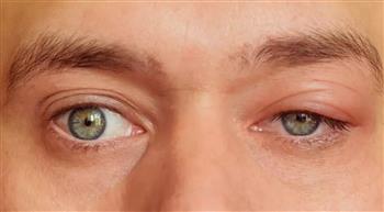 أسباب انتفاخ الجفن العلوي للعين