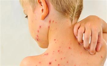 اليابان تسجل زيادة في عدد الإصابات بالحصبة وتحث المواطنين على سرعة تطعيم أطفالهم