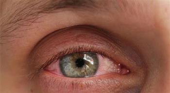 دليلك‭ ‬للحماية‭ ‬من‭ ‬حساسية‭ ‬العين