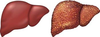 تعرف علي أعراض تليف الكبد